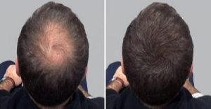 মাথায় নতুন চুল গজানোর দুর্দান্ত উপায়!